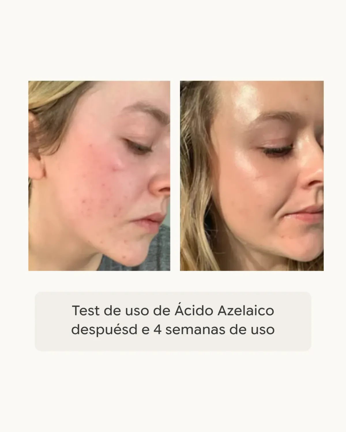 Dhyvana Azelaic Control serum azelainsyre uren hud