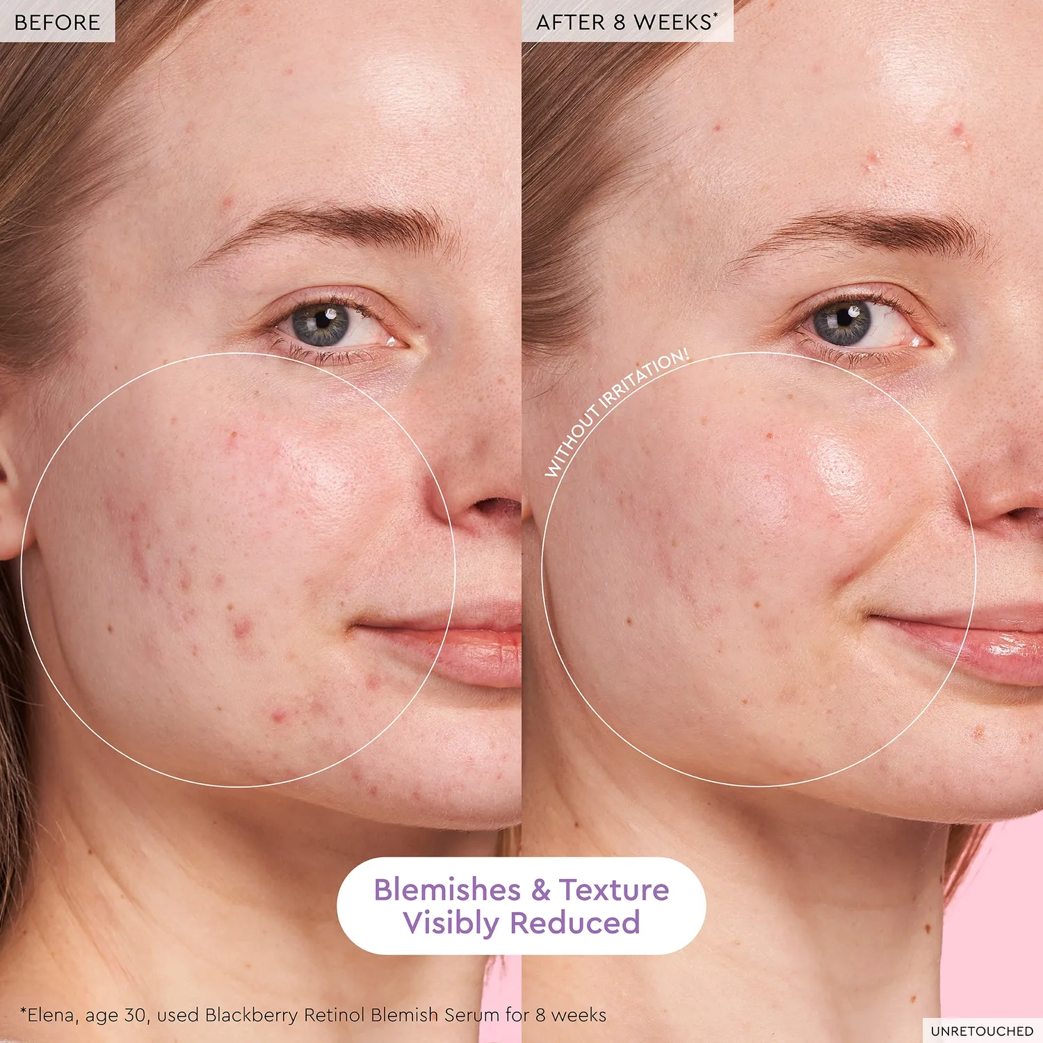 Glow Recipe Blackberry Retinol Blemish Serum 30 ml mod urenheder